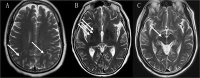 Enlarged perivascular spaces, neuroinflammation and neurological dysfunction in NMOSD patients